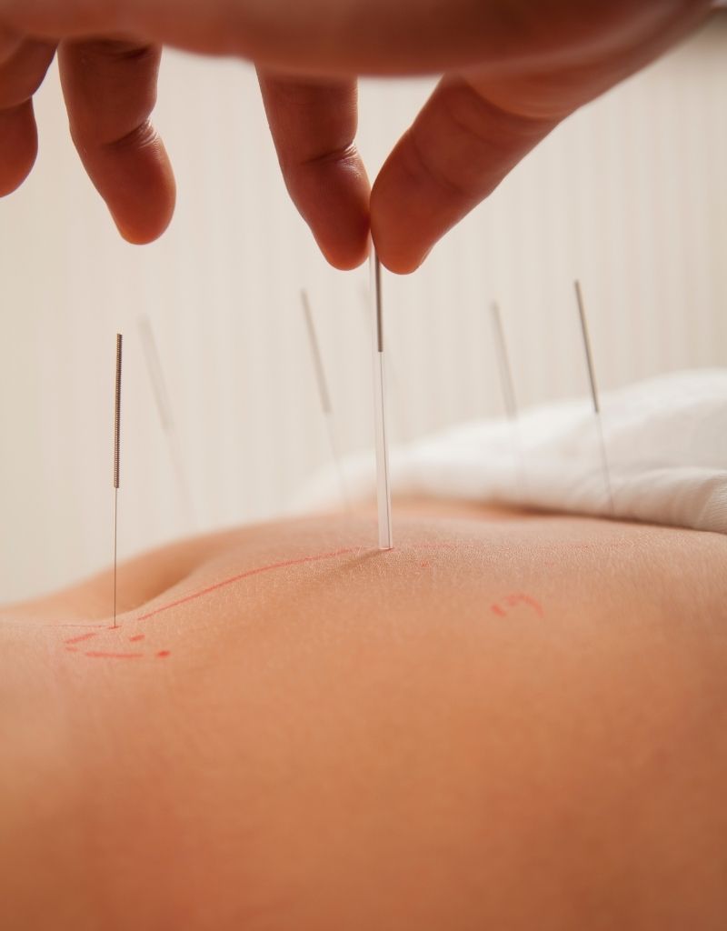 Acupunctuurnaalden worden geplaatst voor de behandeling van nek- en schouderklachten.